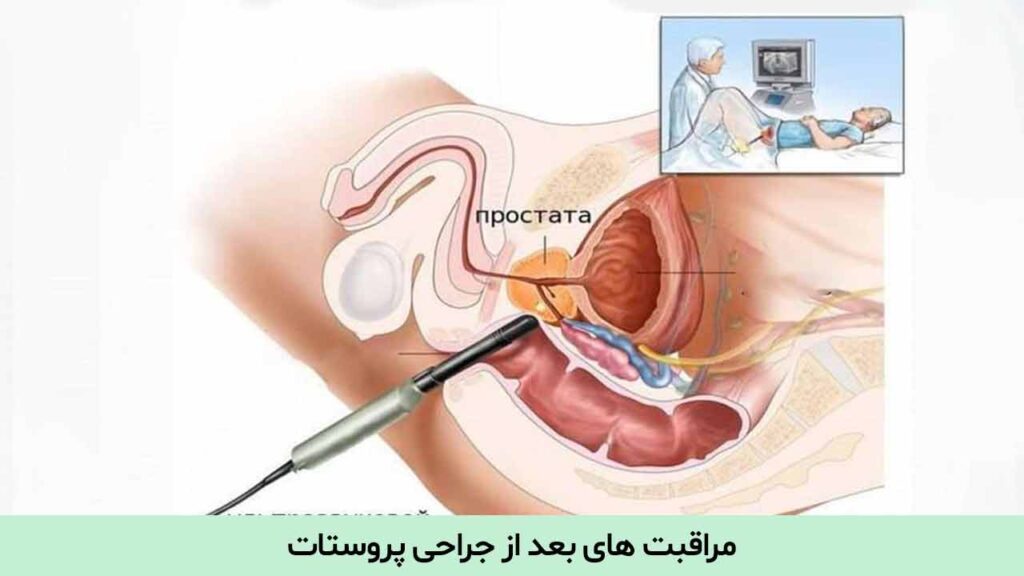 مراقبت های بعد از جراحی پروستات