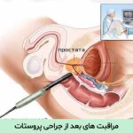 مراقبت های بعد از جراحی پروستات