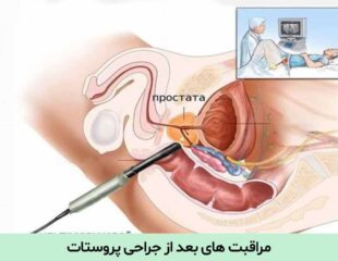 مراقبت های بعد از جراحی پروستات