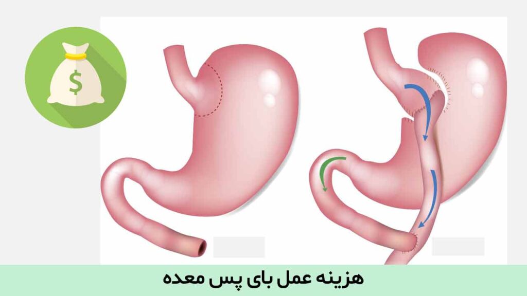 هزینه عمل بای پس معده