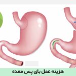 هزینه عمل بای پس معده