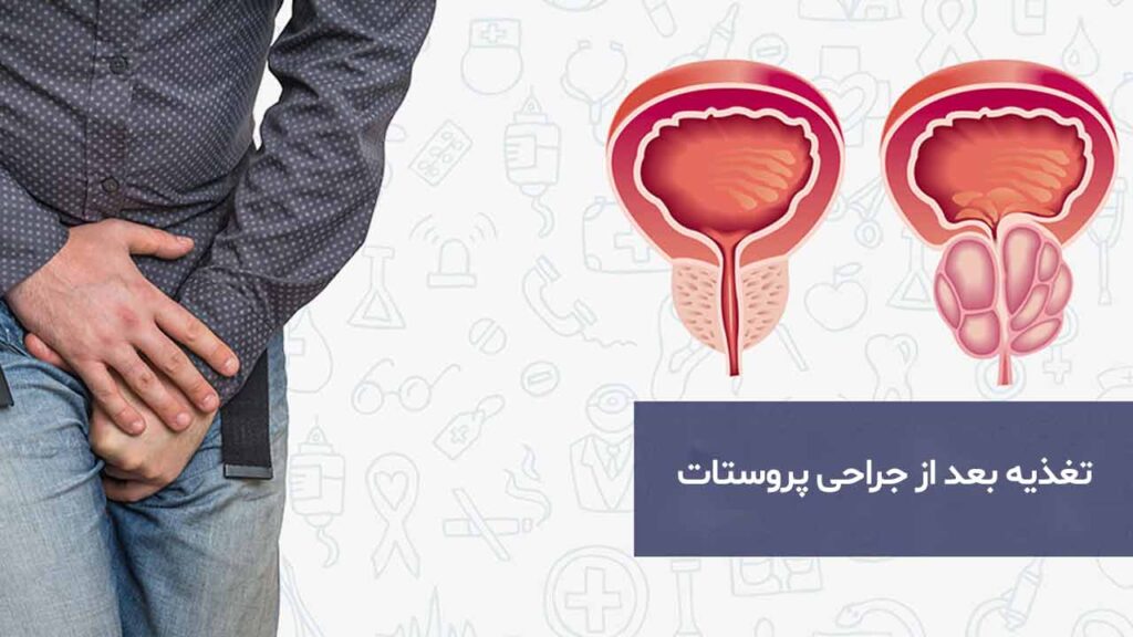  جمع بندی تغذیه بعد از جراحی پروستات