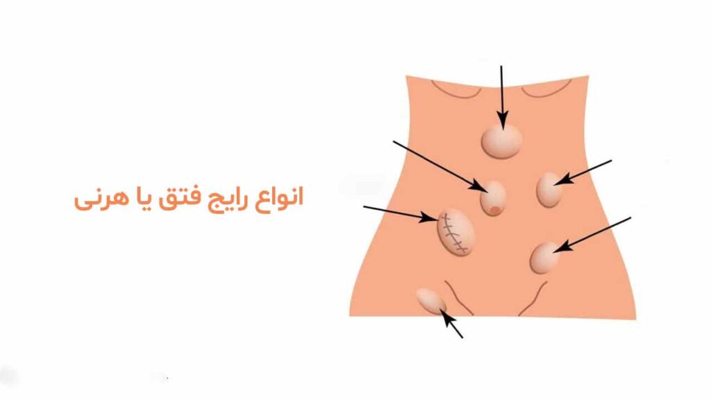 انواع رایج فتق یا هرنی