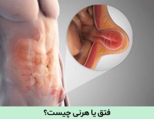 فتق یا هرنی چیست؟