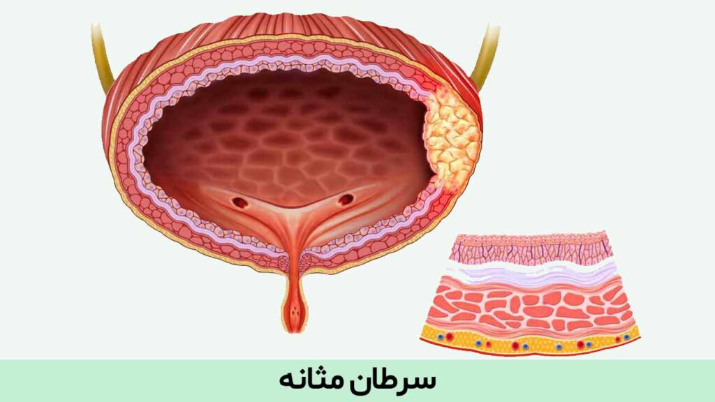 سرطان مثانه