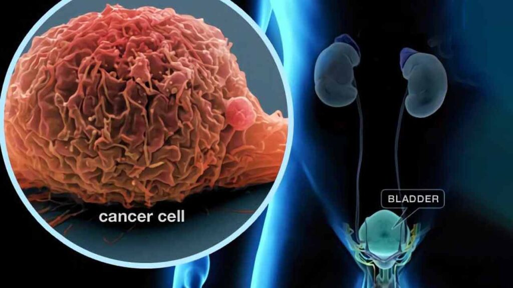 سرطان مثانه چیست؟