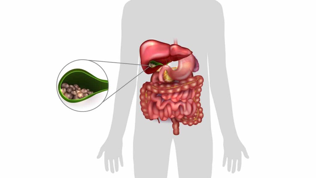 عوارض التهاب حاد کیسه صفرا یا کله سیستیت