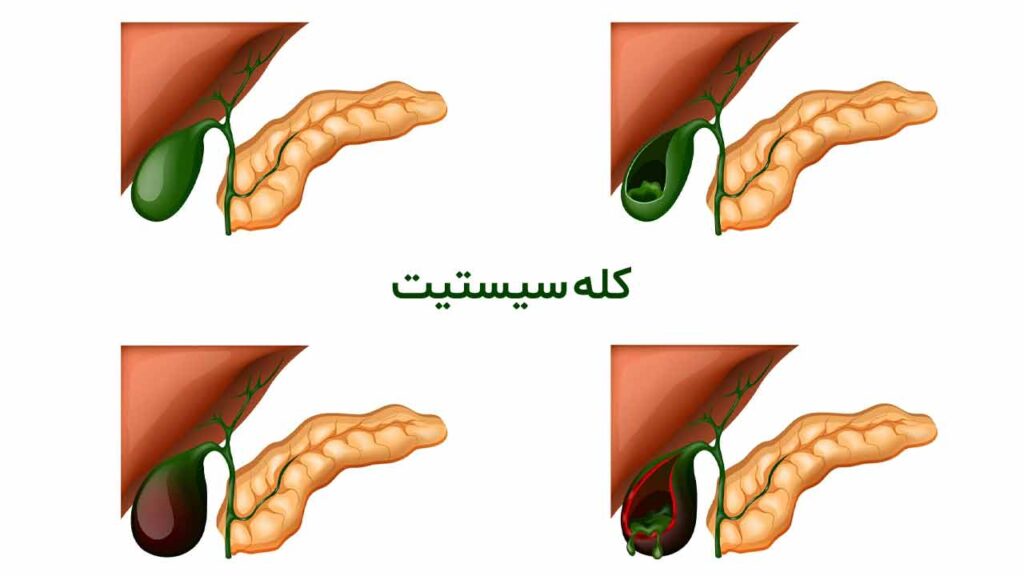 کله سیستیت یا التهاب حاد کیسه صفرا چیست؟