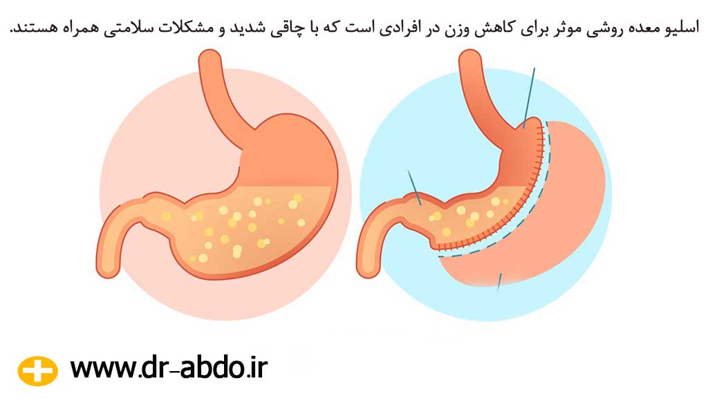 عمل اسلیو معده چیست؟