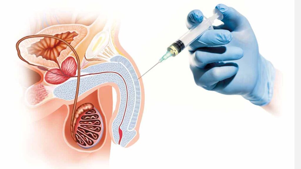 تزریق ژل به آلت تناسلی