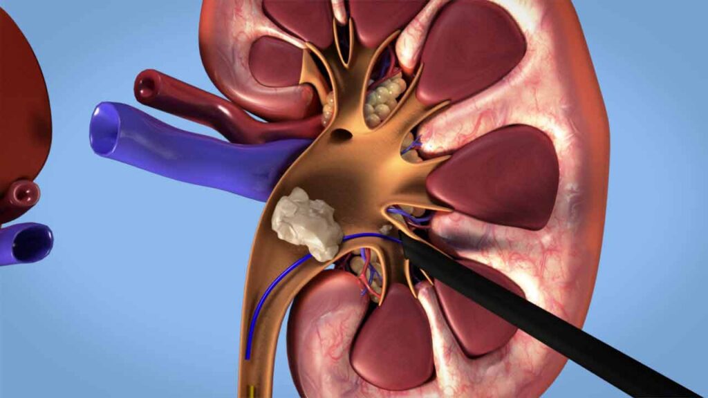 عمل pcnl چیست؟| خارج کردن سنگ کلیه از راه پوست- dr-abdo
